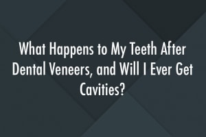 What-Happens-to-My-Teeth-After-Dental-Veneers-and-Will-I-Ever-Get-Cavities